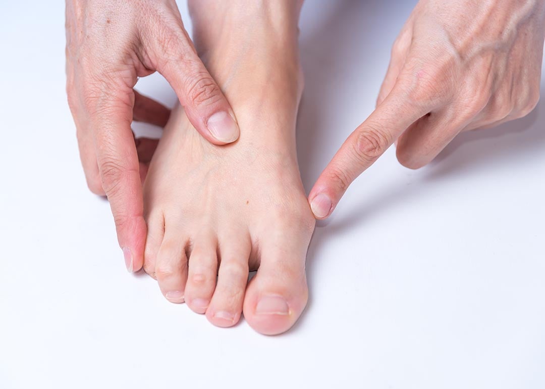 Got bunions? Here are 6 things you should know