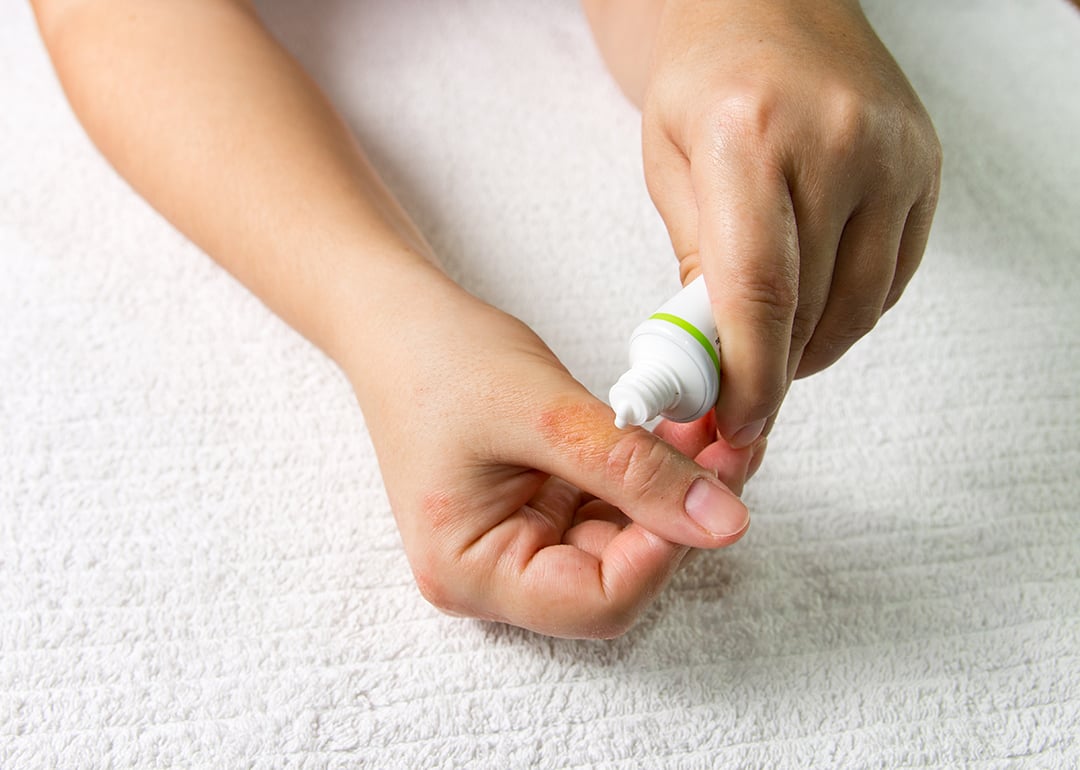 7 eczema medications to help for better skin control