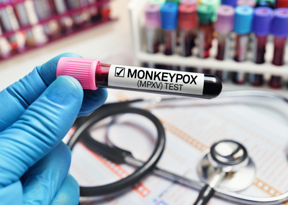 Researcher holding test tube with monkey pox virus.