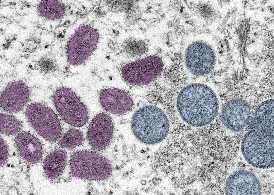 Electron microscopic image if monkeypox virion