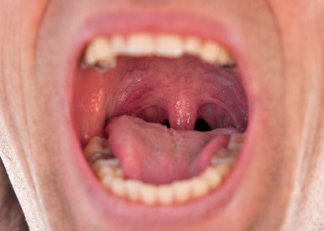 A person's open mouth, through which their tonsils are visible.