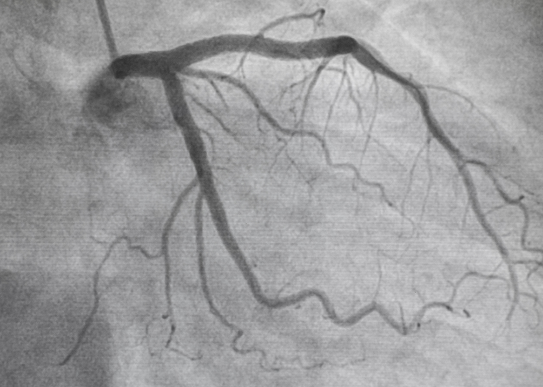 Left coronary angiography showing a person's arteries.