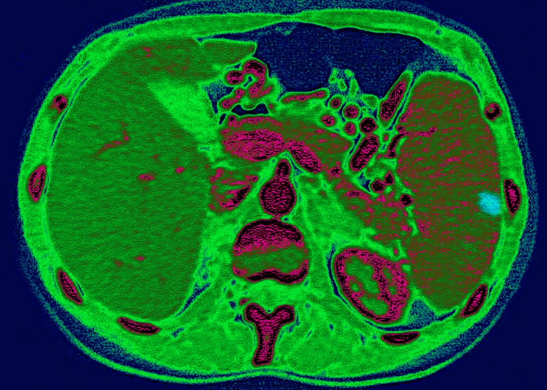 Spleen infarction, as seen on a radial section CT scan of the abdomen.
