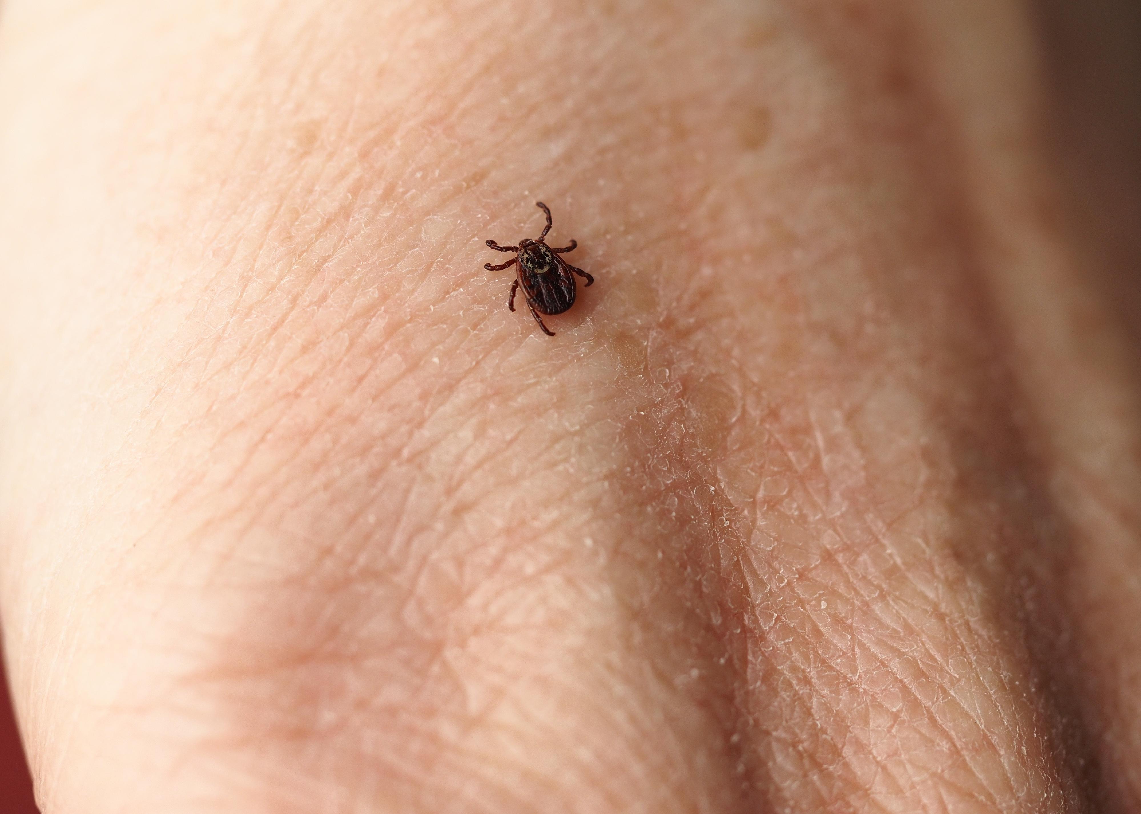 Close-up of an encephalitic live tick on the human body.