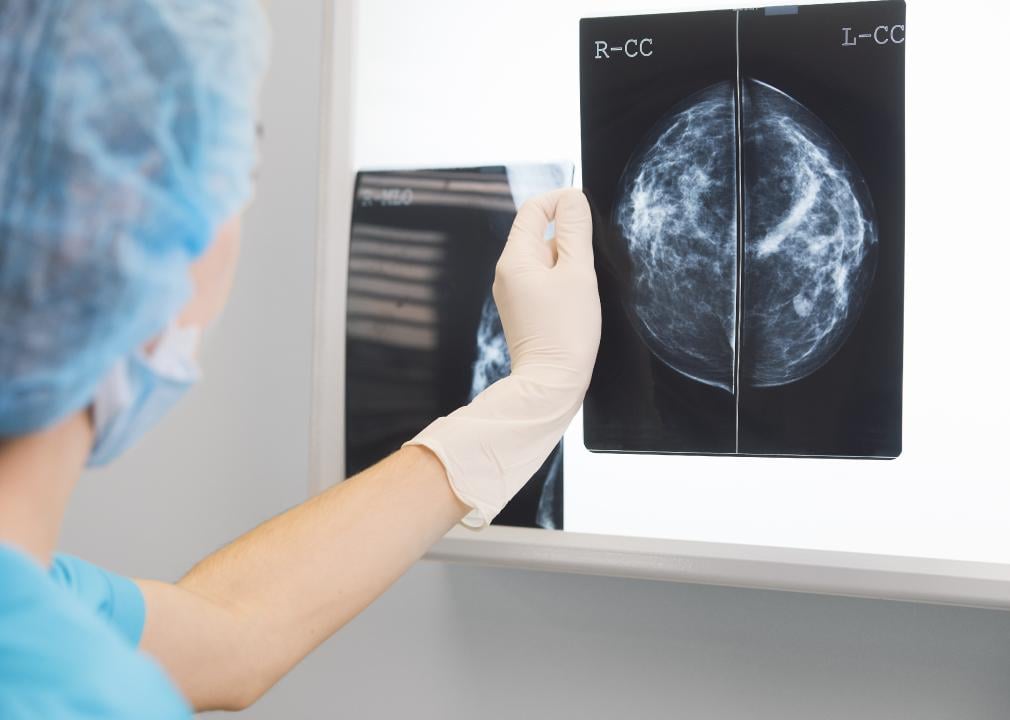 Doctor holding a mammogram in front of x-ray illuminator