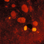 Mycobacterium tuberculosis in a sputum smear.