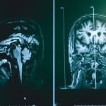 A sample MRI scan of frontotemporal dementia.