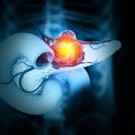 A 3D illustration of cancer forming in the pancreas.