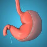 A 3D illustration of the gastric sleeve which is a target for bariatric surgery.