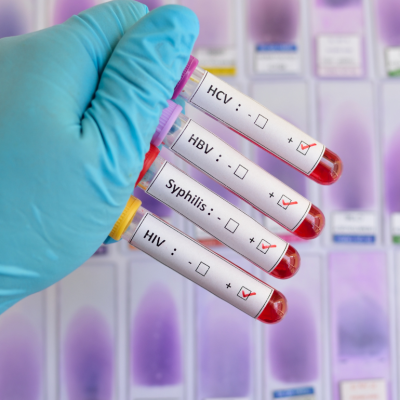 Blood sample vials positive with sexually transmitted infections: HIV, HBV, HCV, Syphilis