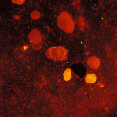 Mycobacterium tuberculosis in a sputum smear.