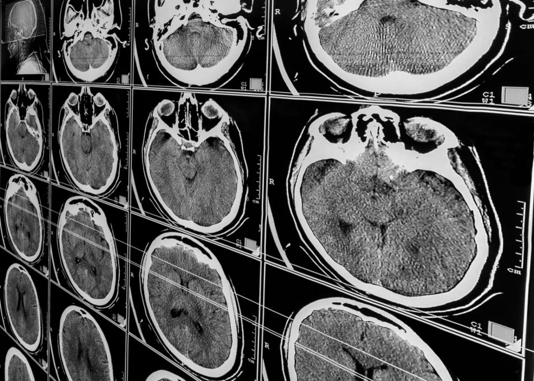 An MRI scan of a traumatic brain injury.