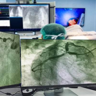 Monitors showing results of a coronary angiogram with doctors and a patient behind it.