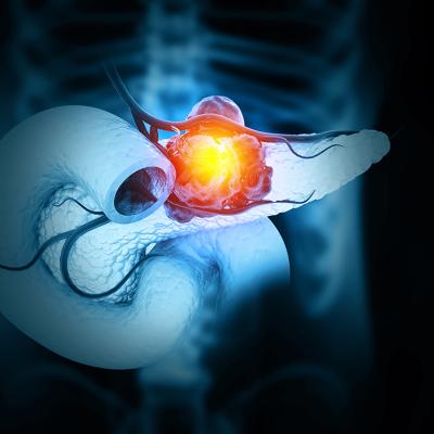 A 3D illustration of cancer forming in the pancreas.