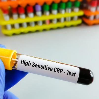 A blood sample tube for hs-CRP (high-sensitive CRP) test.