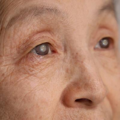 Close up on an elderly woman's eyes with cataracts.
