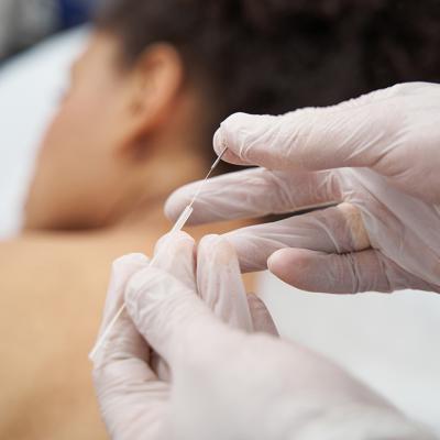 A medical worker preparing acupuncture needles for a muscle relaxation session.