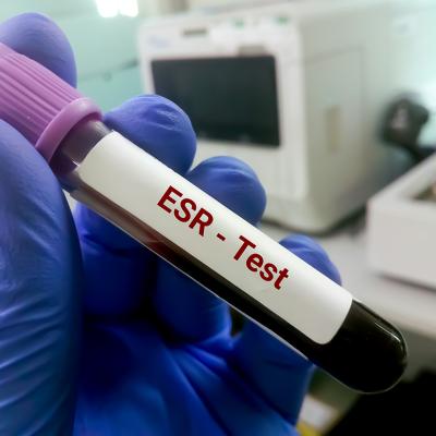A blood sample for an erythrocyte sedimentation rate (ESR) test.