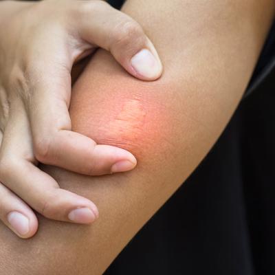 A bee sting stuck from a person's arm. 