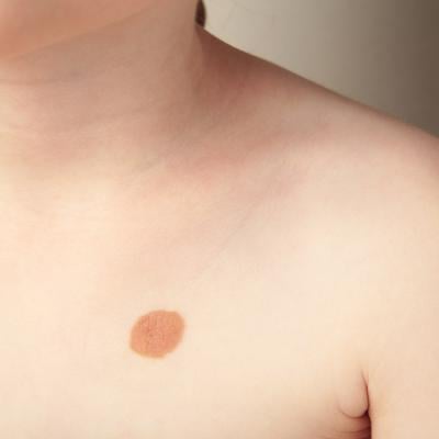 A close-up shot of a big mole on the left side of a child's chest.