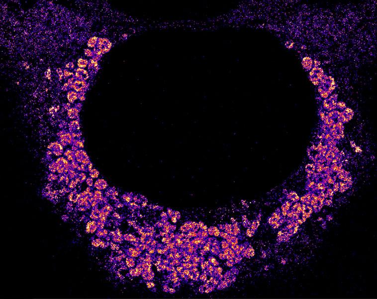 Image of how the Covid-19 virus hides from the cell’s immune system by wrapping itself inside double-membrane bubbles when replicating. The bubbles are seen as clumpy aggregates of the virus’s fluorescently labeled genetic material and the dark circle in the middle is the cell nucleus.
