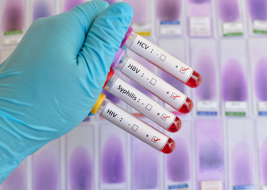 Blood sample vials positive with sexually transmitted infections: HIV, HBV, HCV, Syphilis