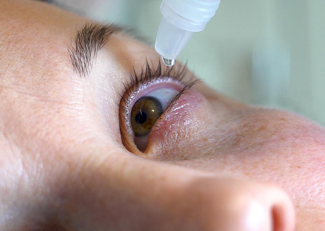 Closeup on the eyes of a woman instilled with a treatment.