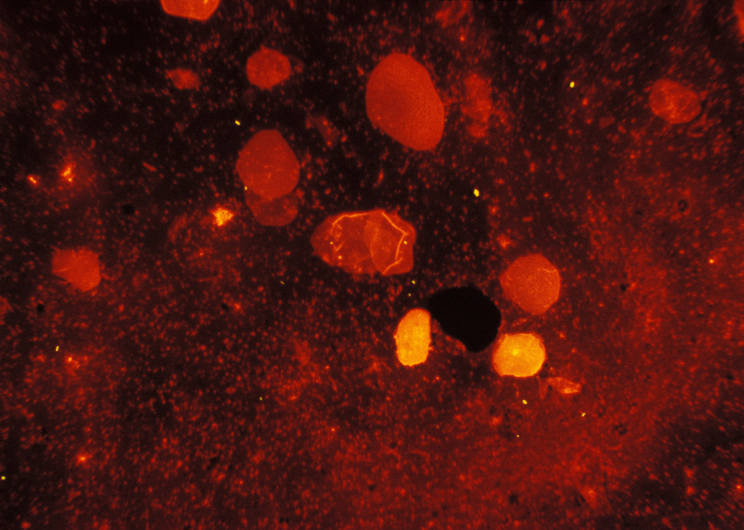 Mycobacterium tuberculosis in a sputum smear.