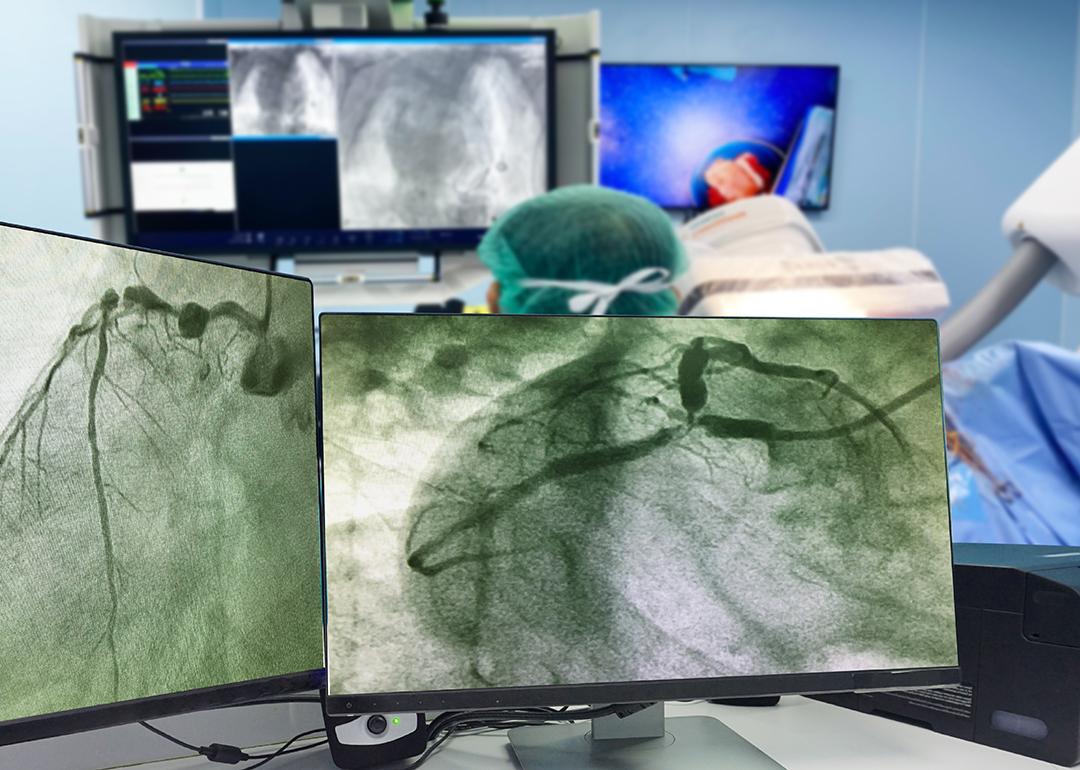 Monitors showing results of a coronary angiogram with doctors and a patient behind it.