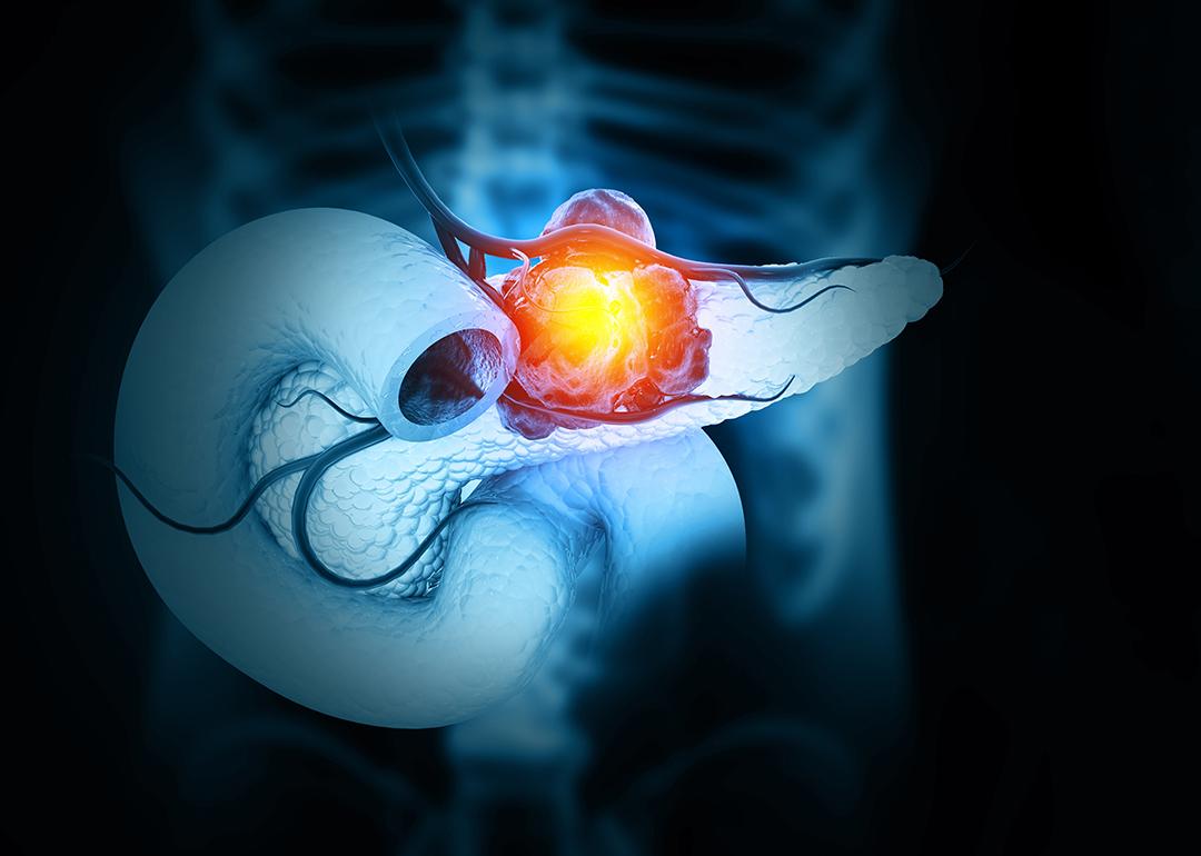 A 3D illustration of cancer forming in the pancreas.