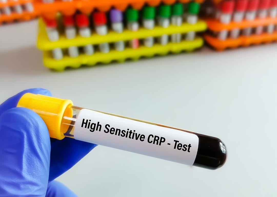 A blood sample tube for hs-CRP (high-sensitive CRP) test.