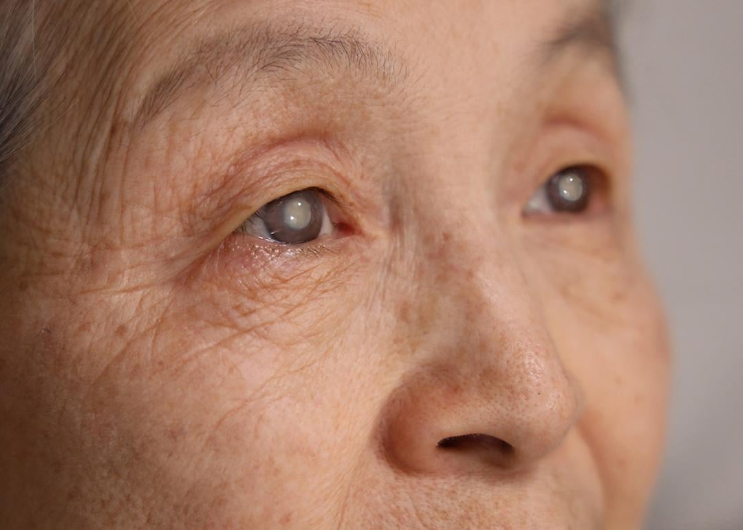 Close up on an elderly woman's eyes with cataracts.