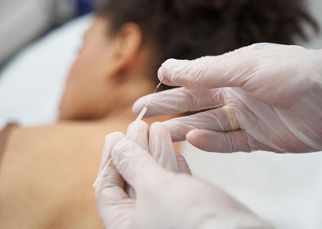 A medical worker preparing acupuncture needles for a muscle relaxation session.