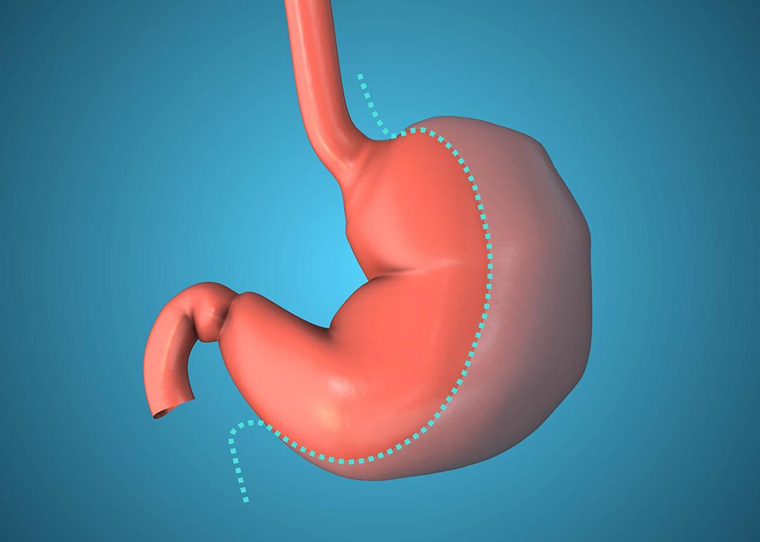 A 3D illustration of the gastric sleeve which is a target for bariatric surgery.