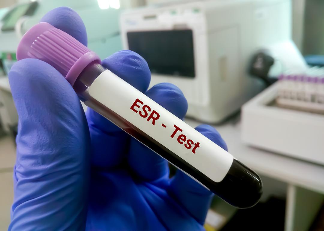 A blood sample for an erythrocyte sedimentation rate (ESR) test.
