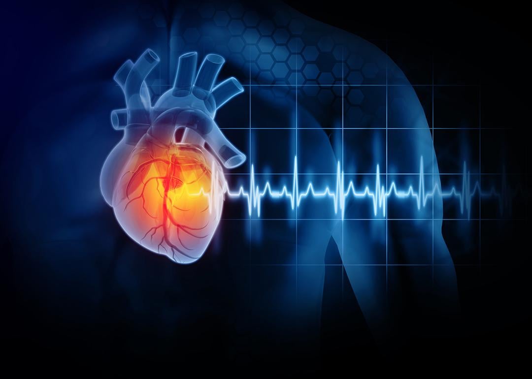 A 3D illustration of a heart attack disease. 