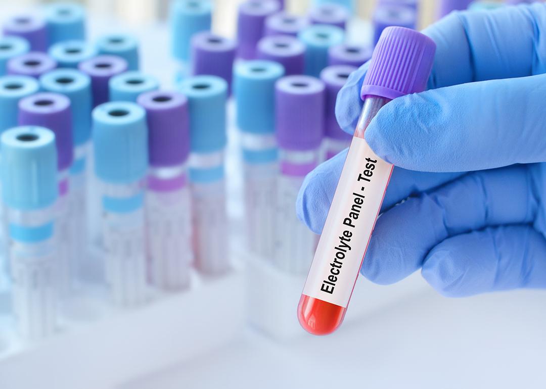 A blood sample tube with an electrolyte panel test label.