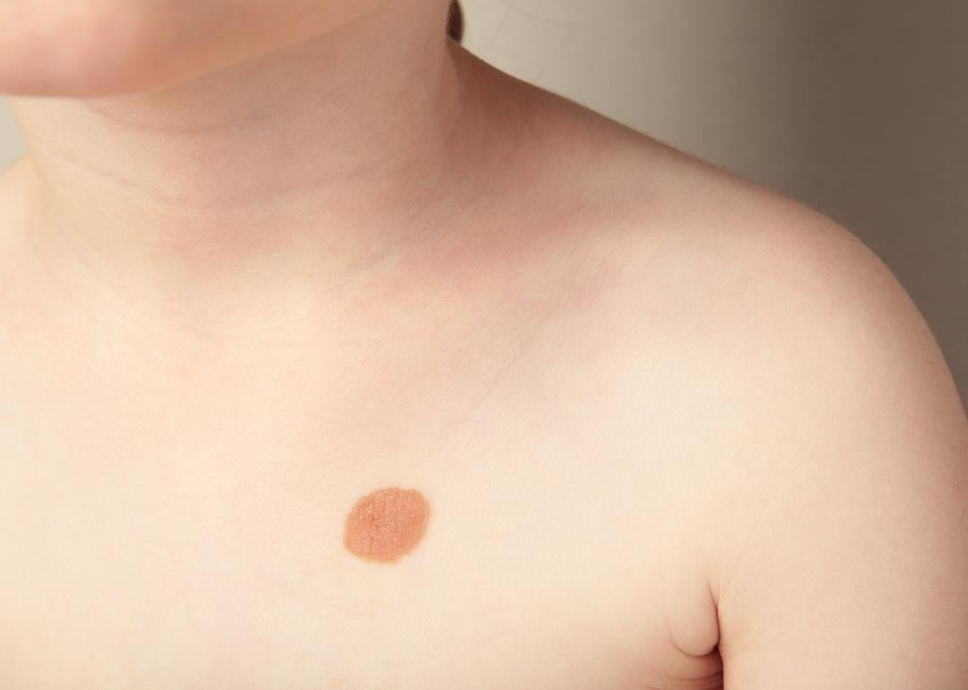 A close-up shot of a big mole on the left side of a child's chest.