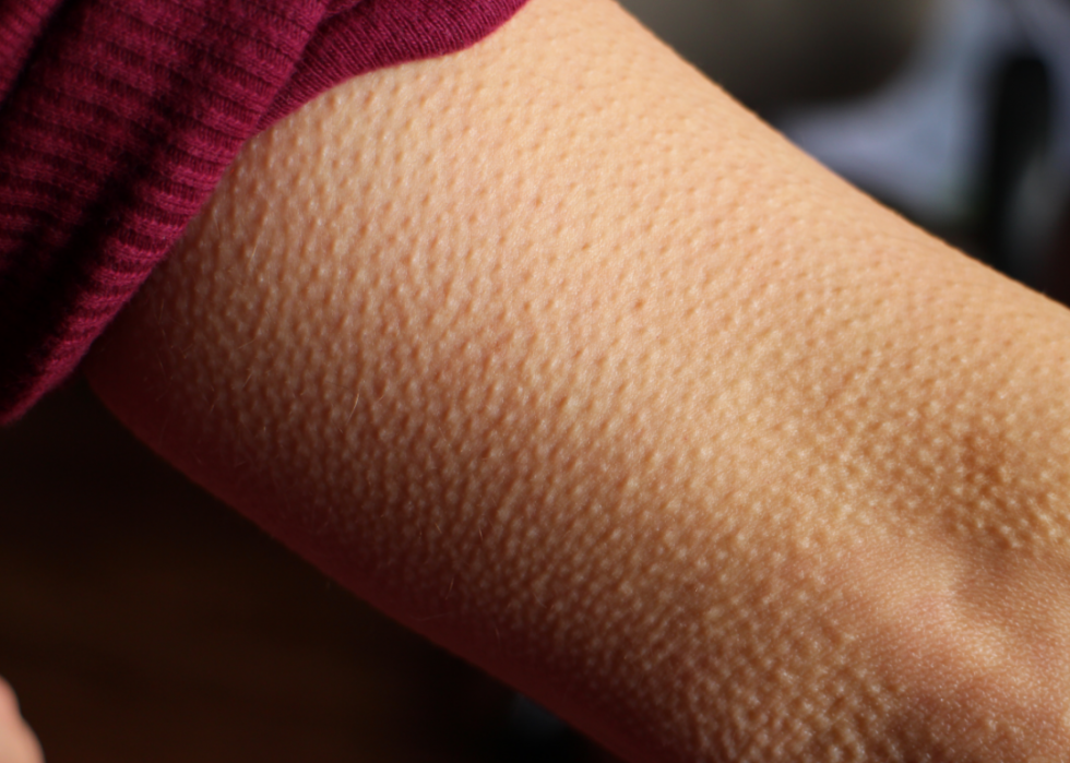 Goosebumps and Other Bodily Reactions, Explained Stacker