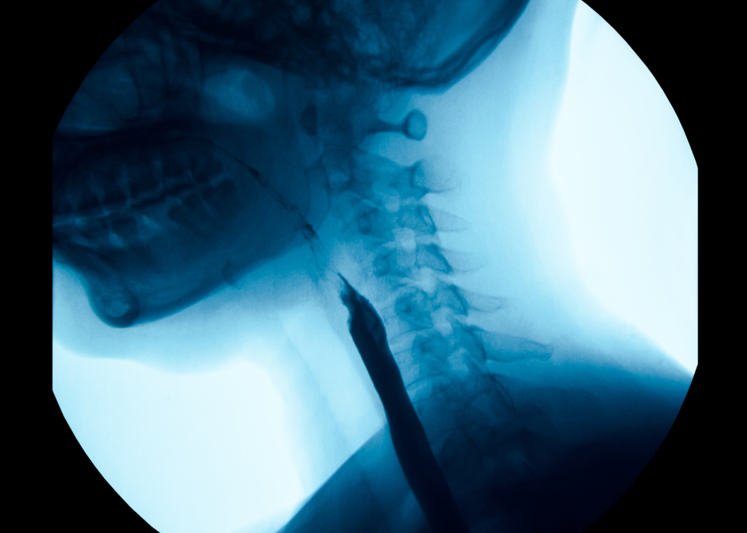 X-ray of the upper gastrointestinal UGI, including the esophagus.