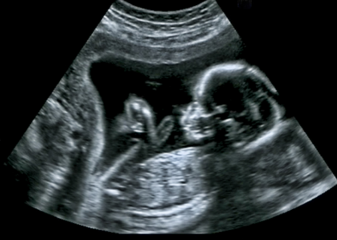 An ultrasound of a fetus in the womb.