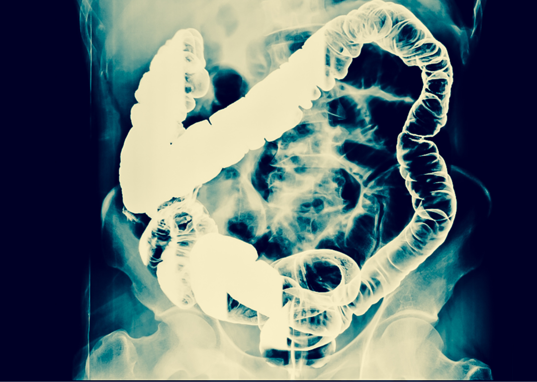 An X-ray of a person's abdomen.