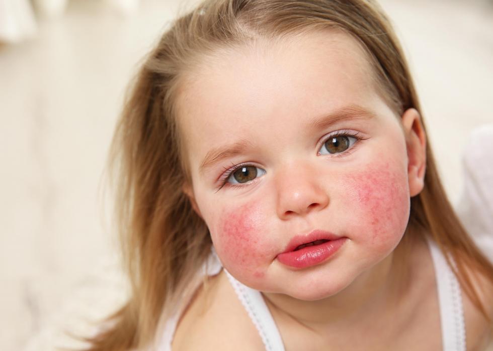 25 faits sur les allergies alimentaires 