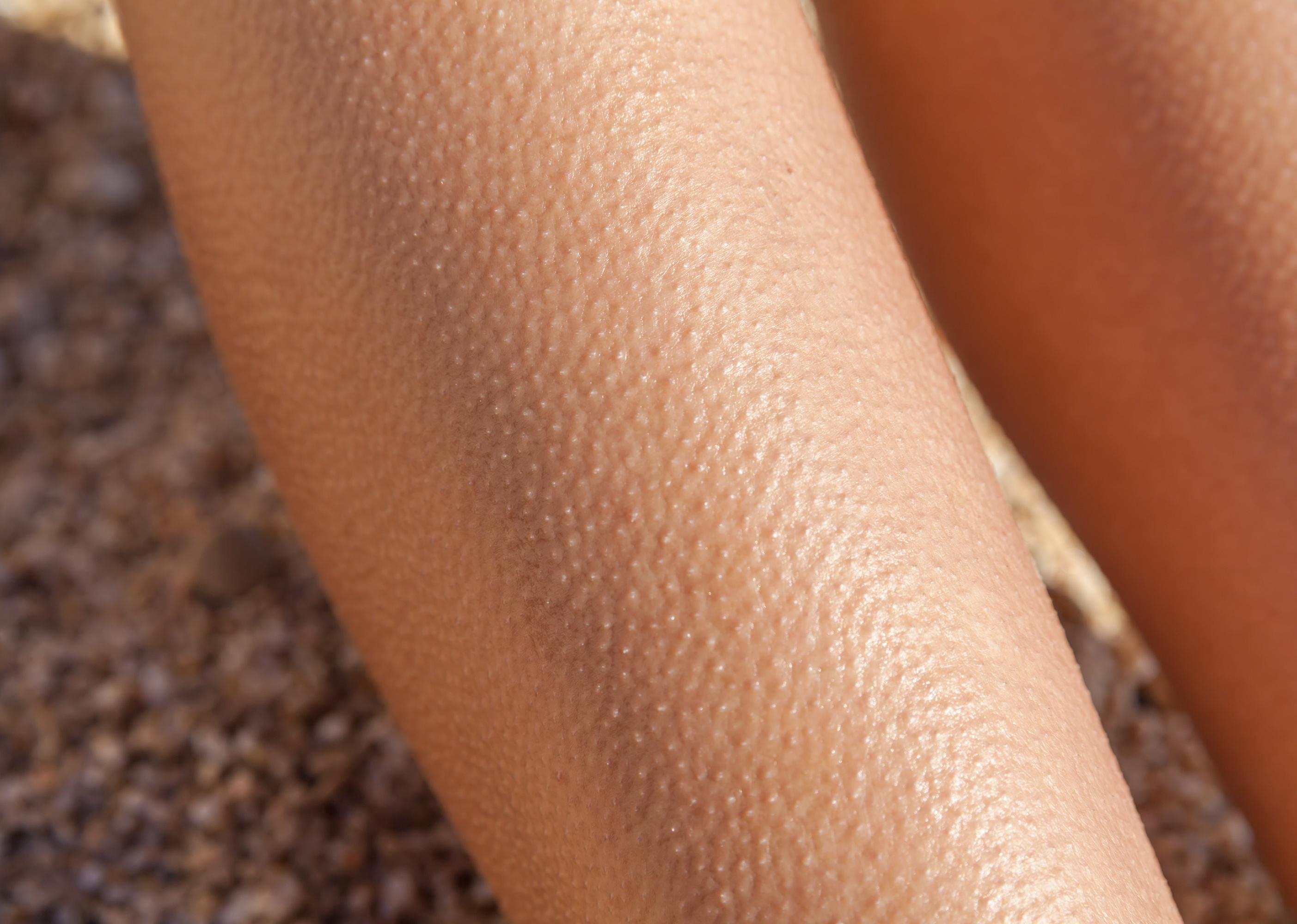 Close up of goosebumps on a persons legs.