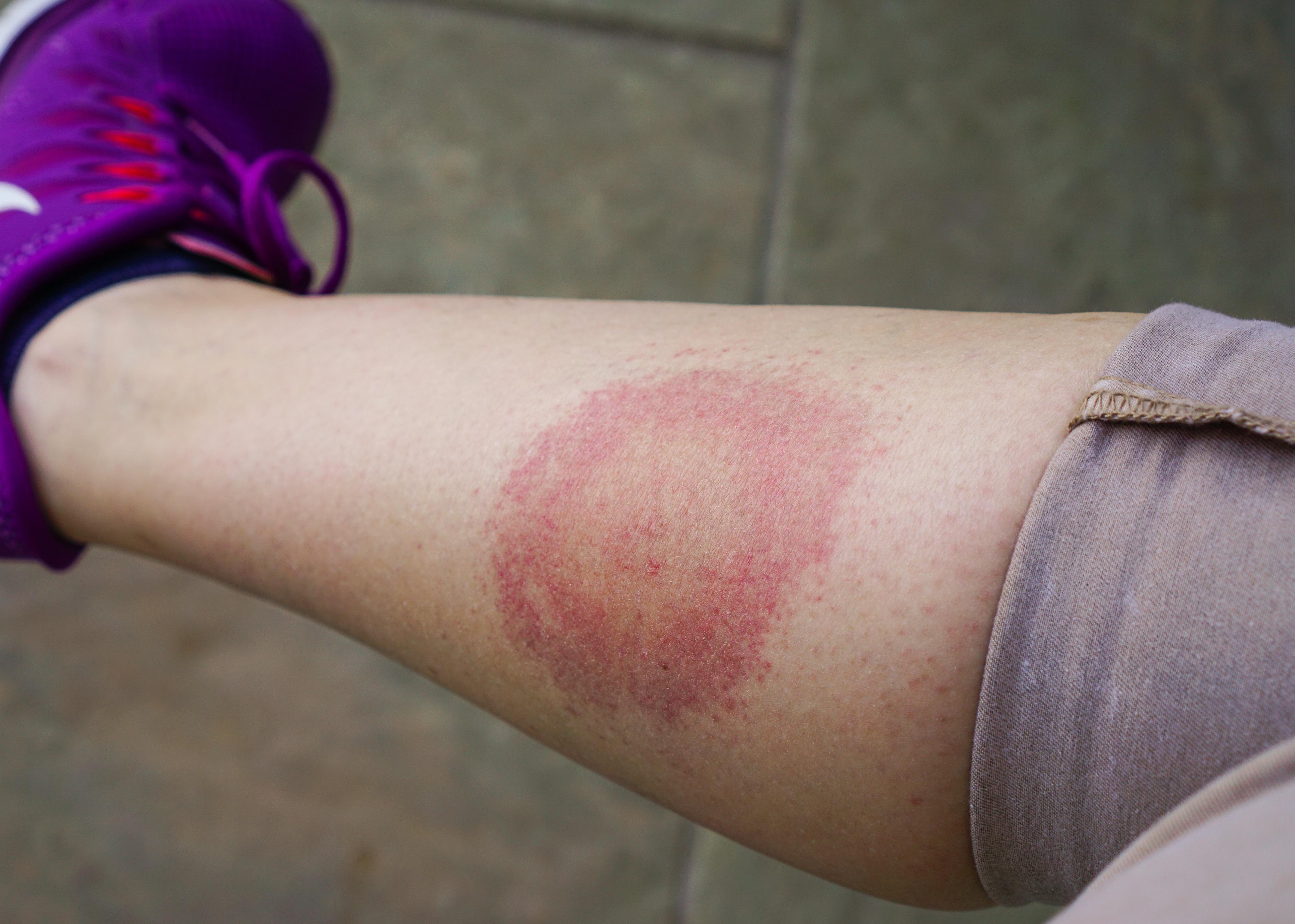 A close up of a person's leg bitten by a tick.